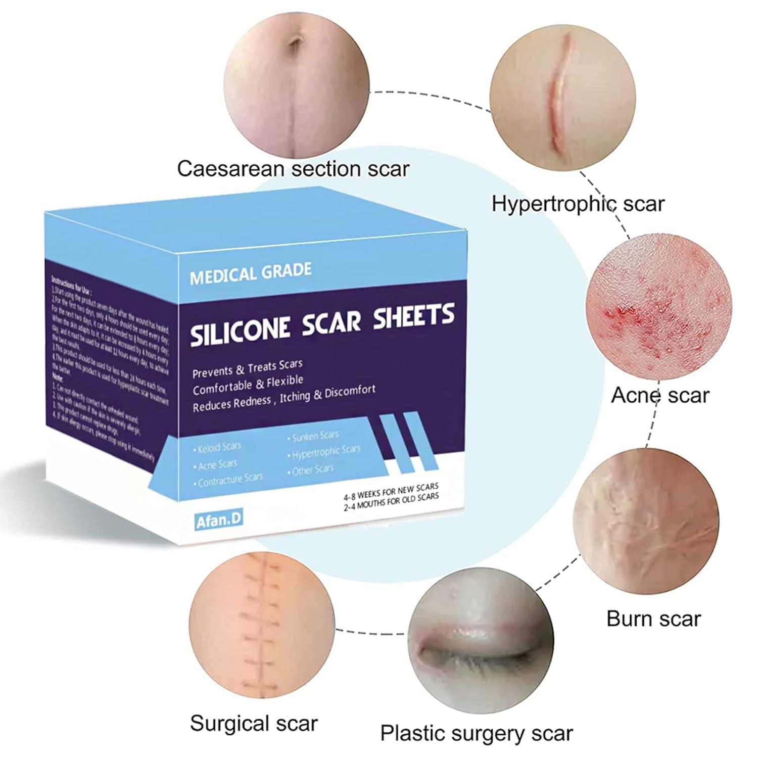 Silicone Scar Tape, Silicone Scar Sheets, Scar Tape Iceland - View #11