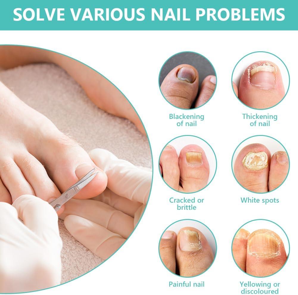 Effective Nail Fungus Treatment Kit | Elim Spa Products