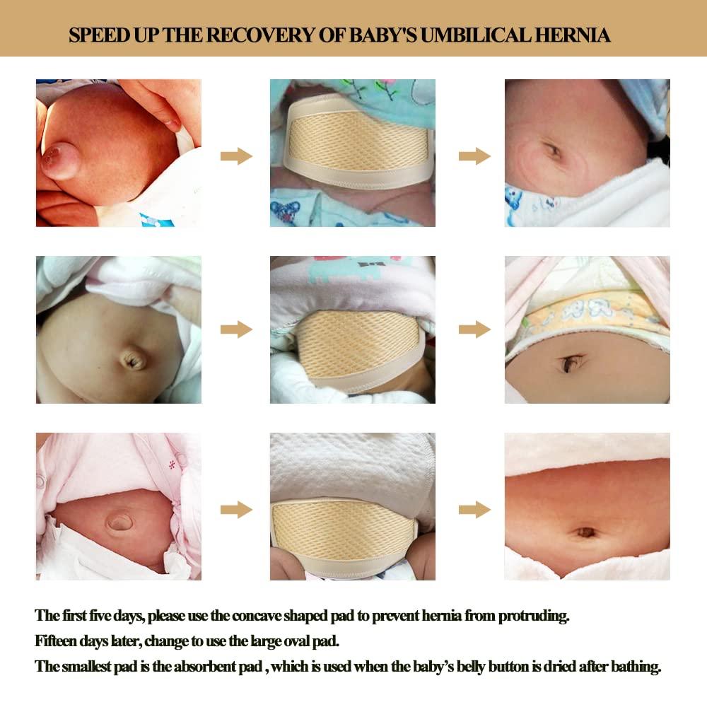 Umbilical Hernia In Babies: All That You Need To Know