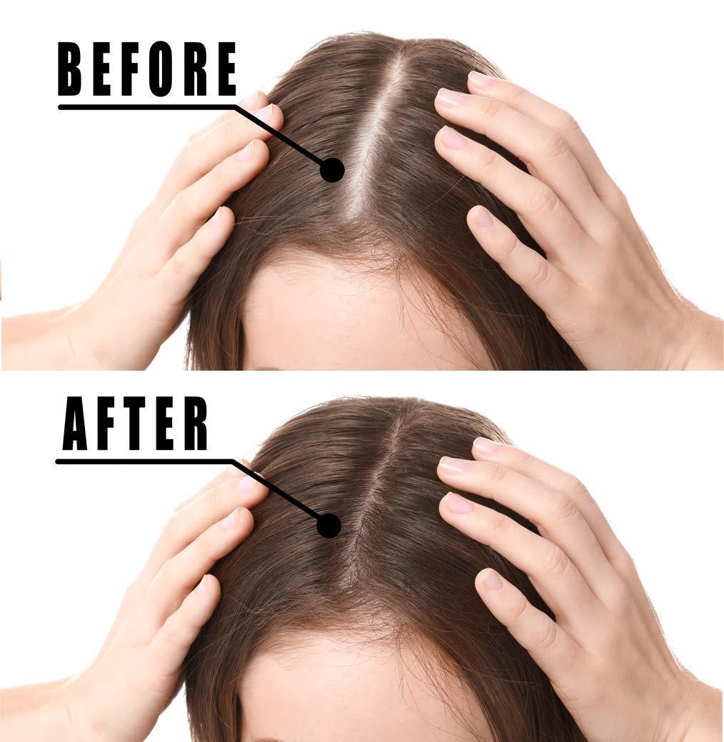 Hair Growth Serum, VOTALA Hair Growth Treatment, Anti Hair Loss, Promotes Thicker, Stronger Hair, And Hair Regrowth for Men Women Hair Growth Serum, VOTALA Hair Growth Treatment, Anti Hair Loss, Promotes Thicker, Stronger Hair, And Hair Regrowth for Men Women