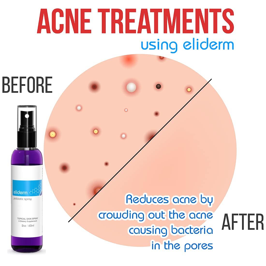 Topical Probiotic Spray for Skin 13 Live Strains Skin Care for Acne