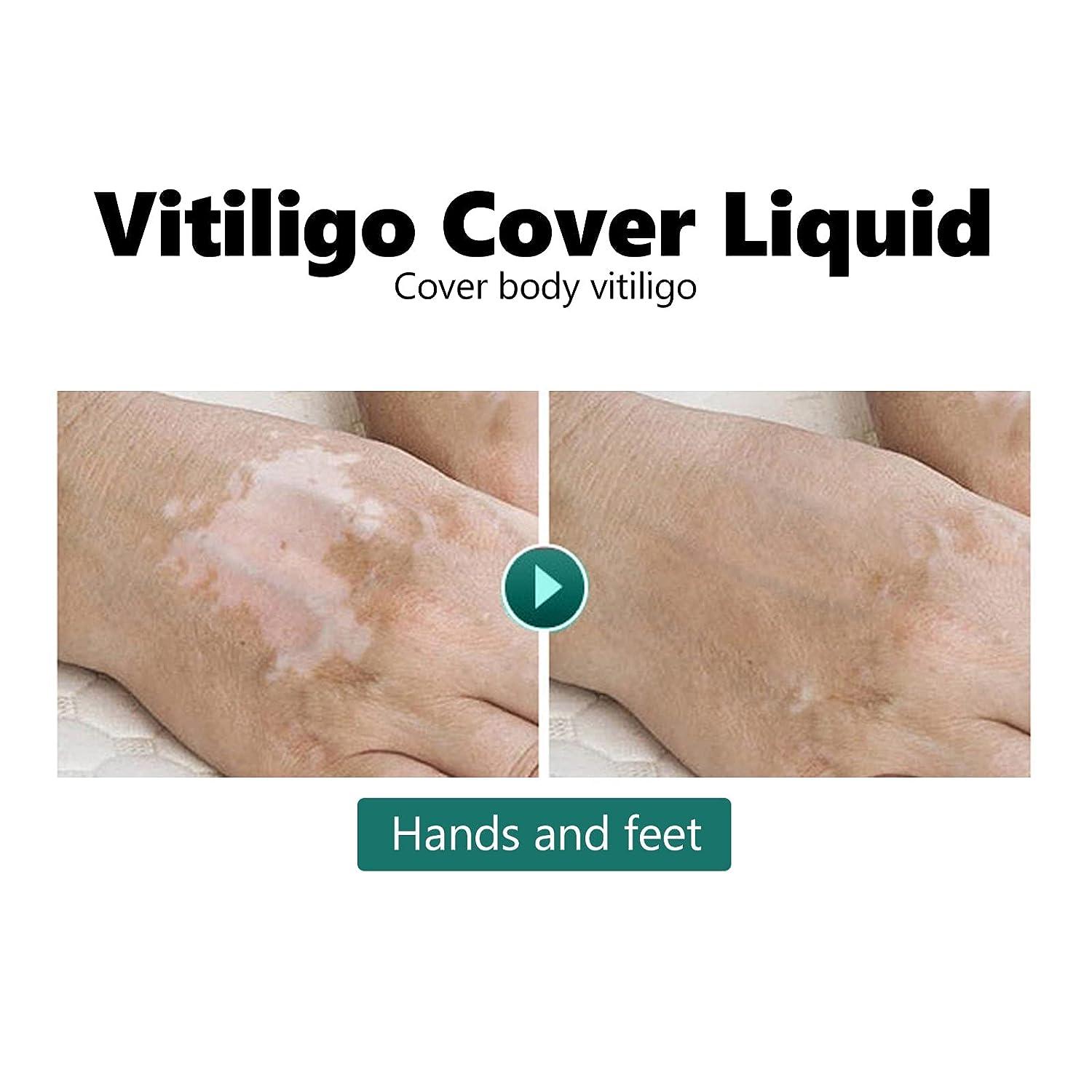 Vitiligo Cover Liquid, Vitiligo CoverUp Makeup Use on Body, For Legs
