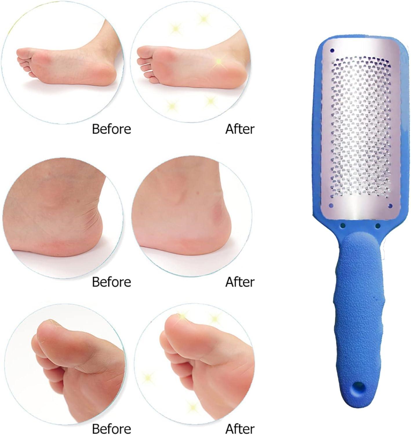 Dead skin top removal pedicure
