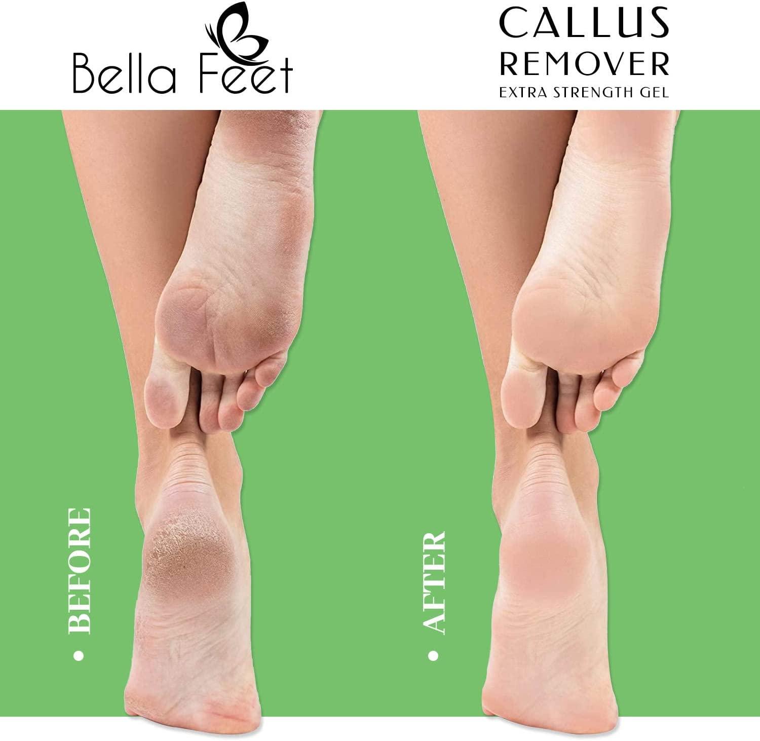 Bella Feet Callus Remover Kit ExtraStrength Callus Remover Gel with