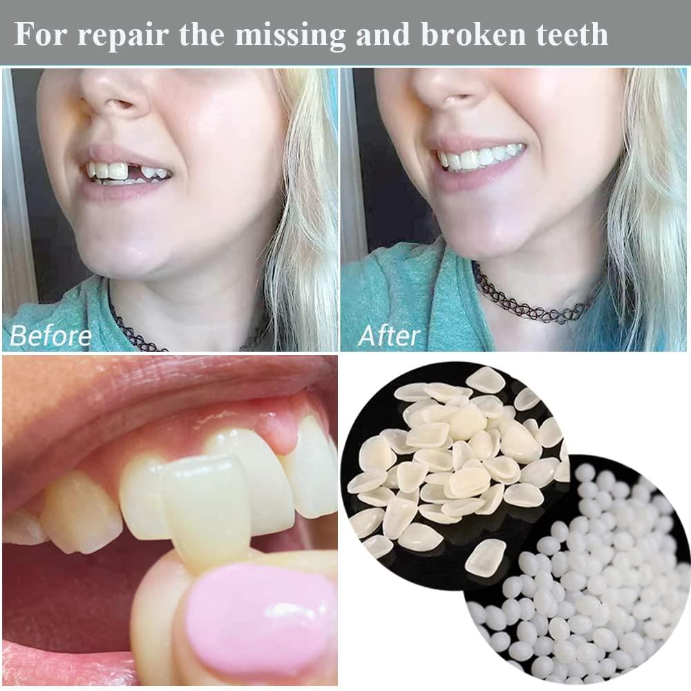 Tooth Repair Kit for Fixing the Missing Chipped and Broken Tooth Gap  Temporary Replacement Thermal Beads and Fake Teeth Brace Mold