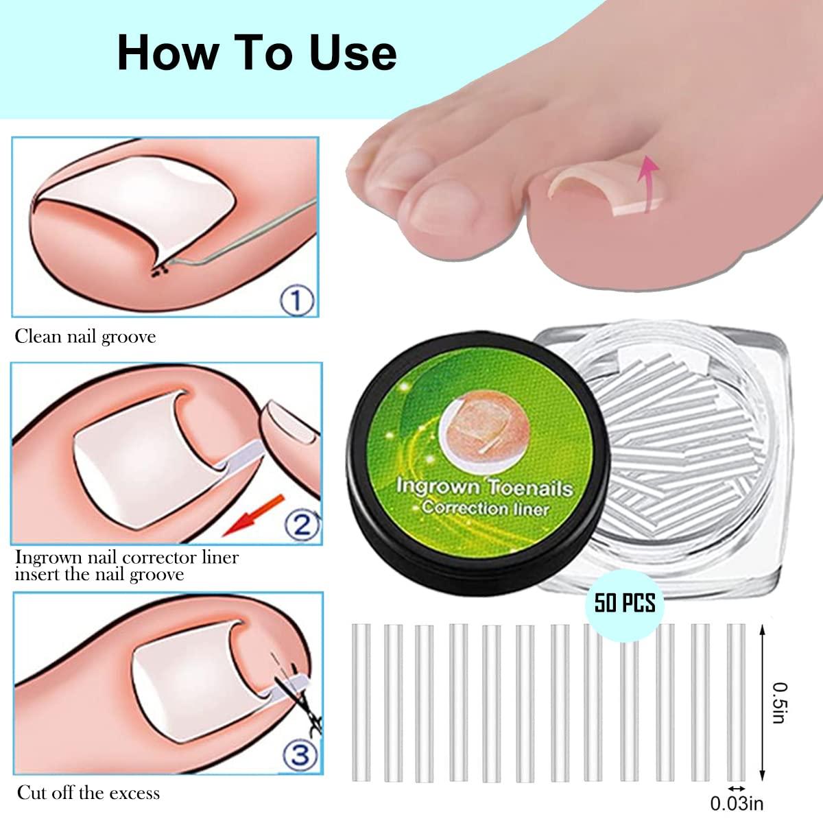 Ingrown Toenail Correction Treatment Kit 50 pcs Corrector Strips, 5pcs Clippers, 6pcs Toe