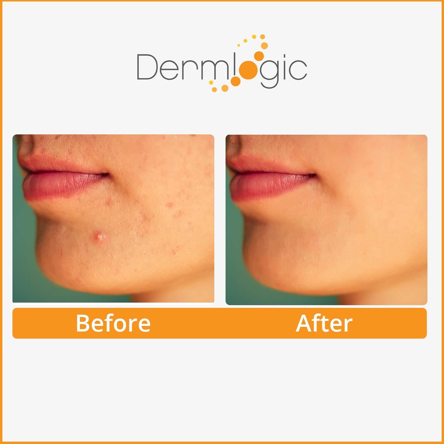 Dermlogic Acne Treatment PadsContains Glycolic, Lactic, Salicylic Acid