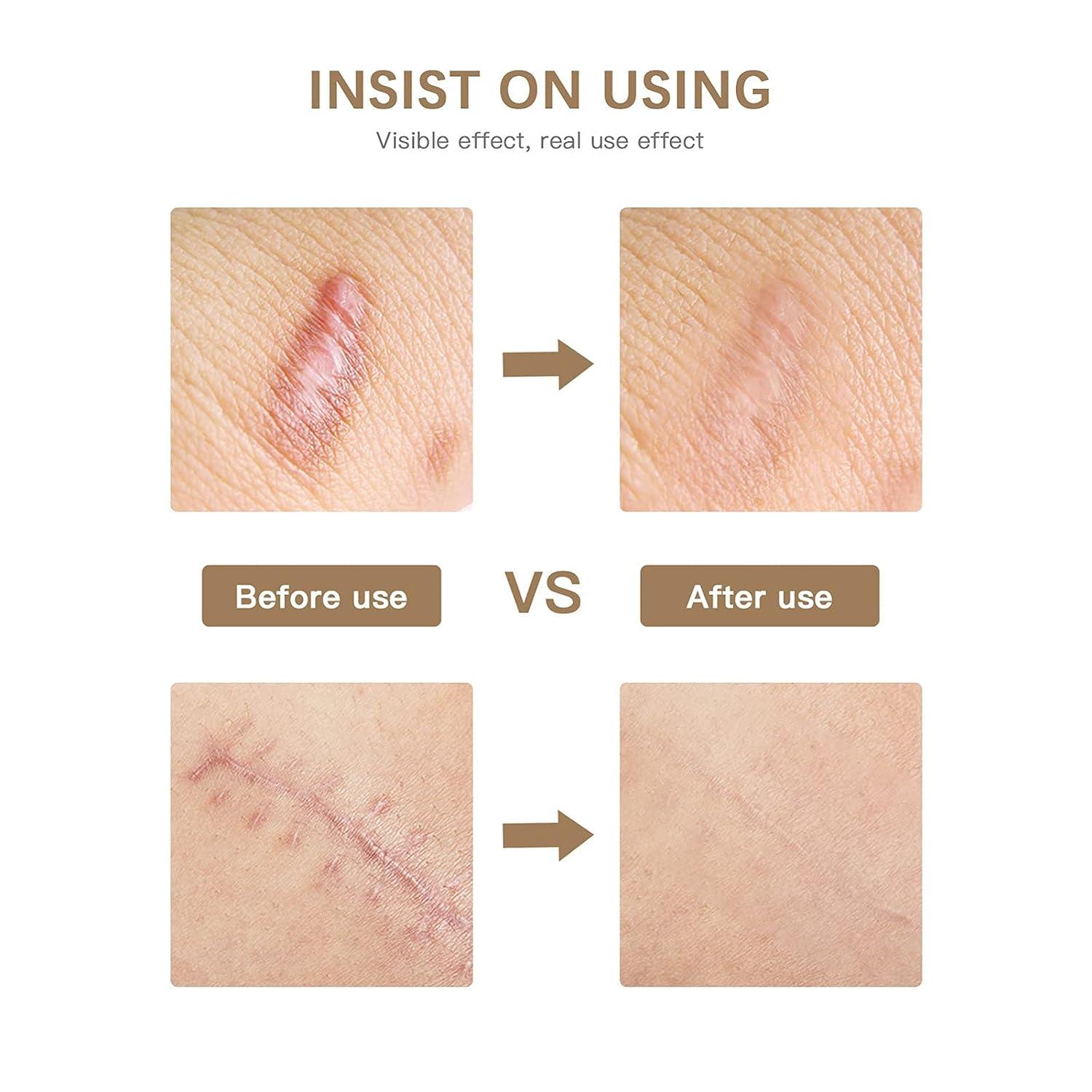 COHEALI Silicone Scar Strips Silicone Scar Removal Sheet 1 Roll Scar Removal Tapes Scarring