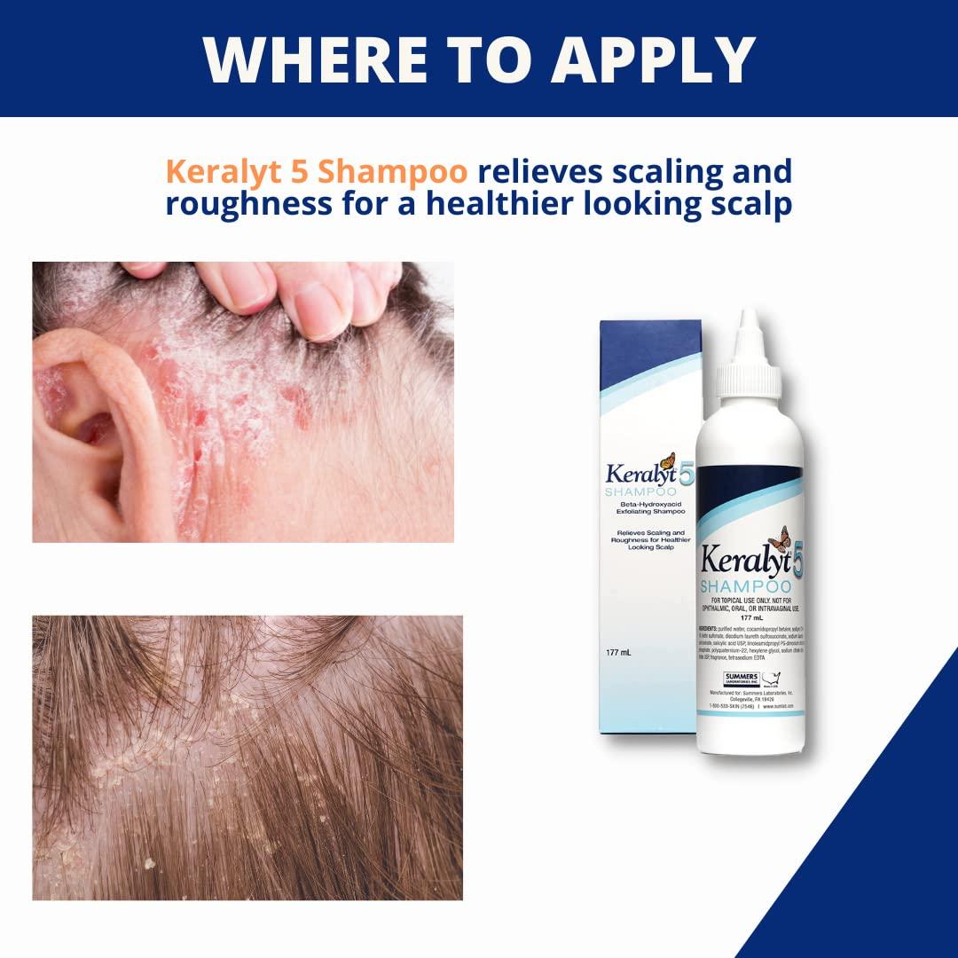 Keralyt 5 AntiDandruff Shampoo Max Strength 5 Salicylic Acid Scalp