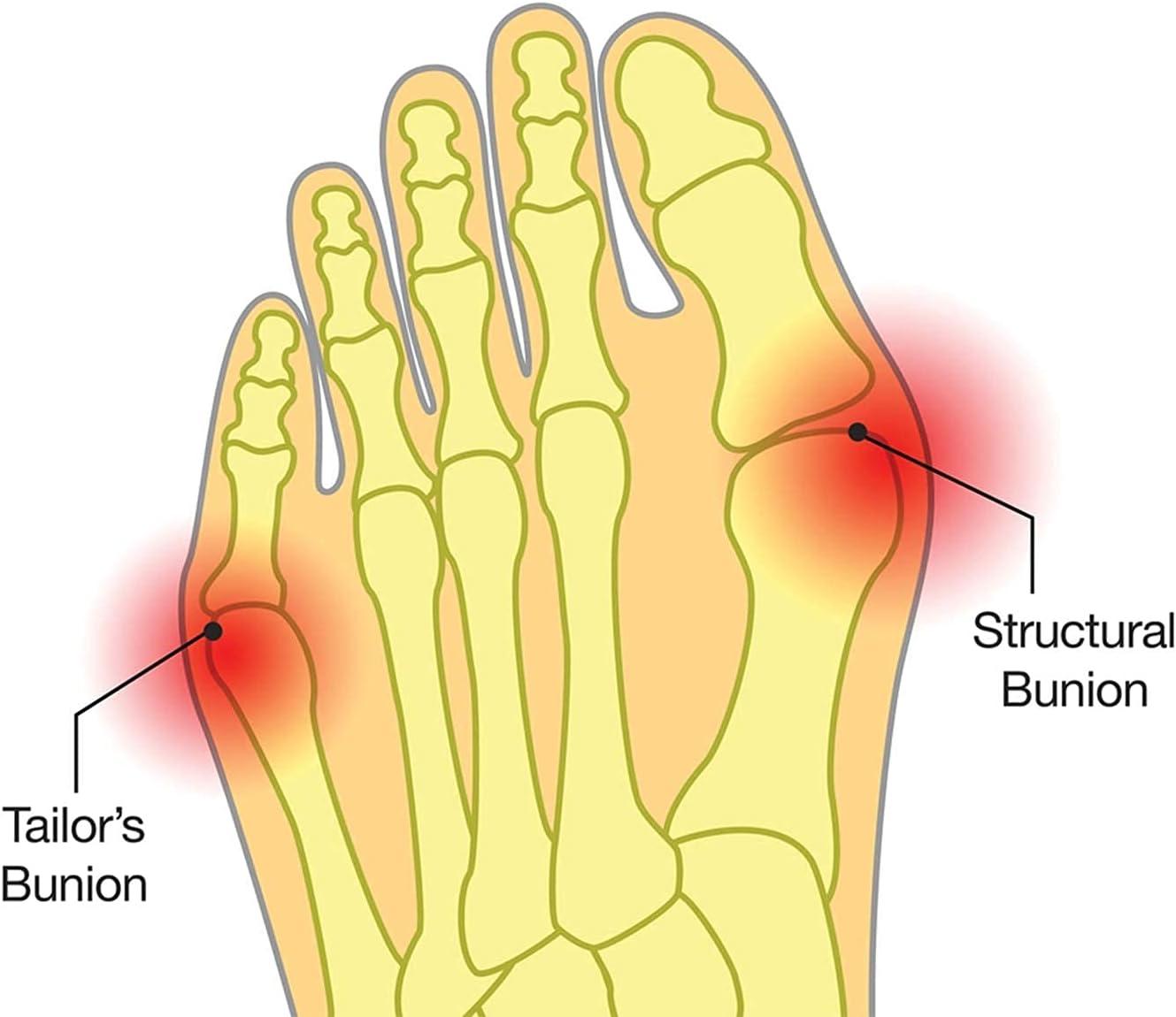 Bunion Corrector Bunion Toe Straightener and Bunion Relief Detox