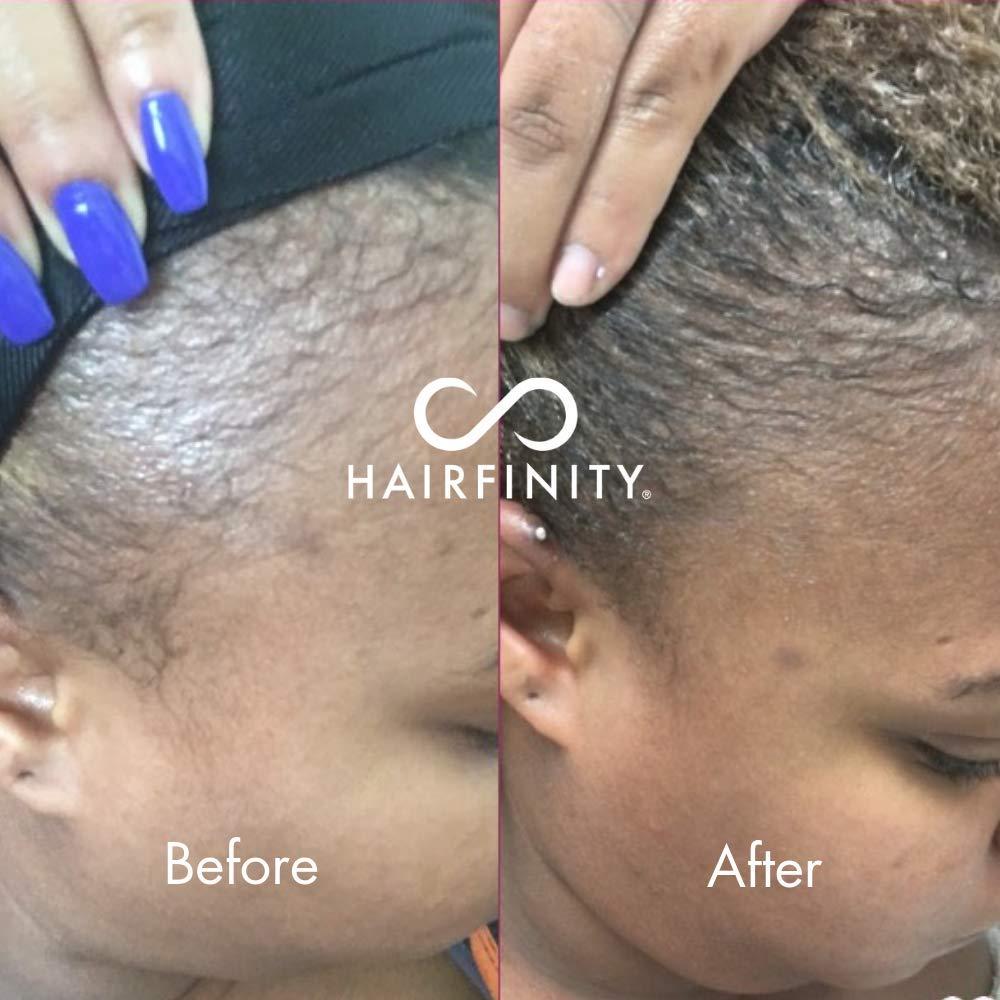 Hairfinity Infinite Edges Hair Serum Hair Growth Treatment to Prevent Hair Loss and Stimulate