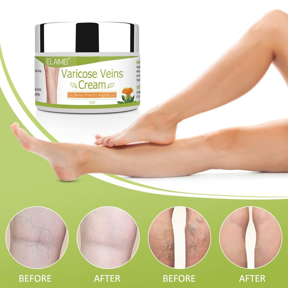 ND Varicose Veins Cream for Legs Eliminate Varicose Veins and Spider