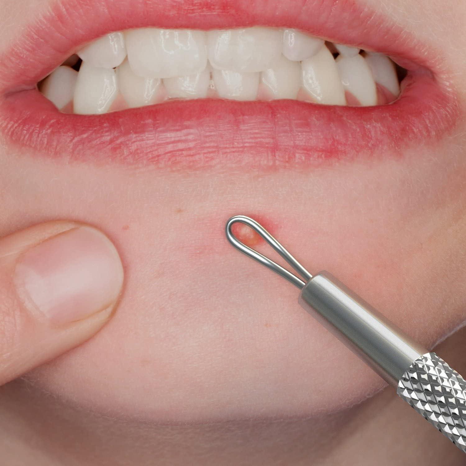 Suvorna Skinpal s90 Loop Whitehead Blackhead Acne & milia Remover