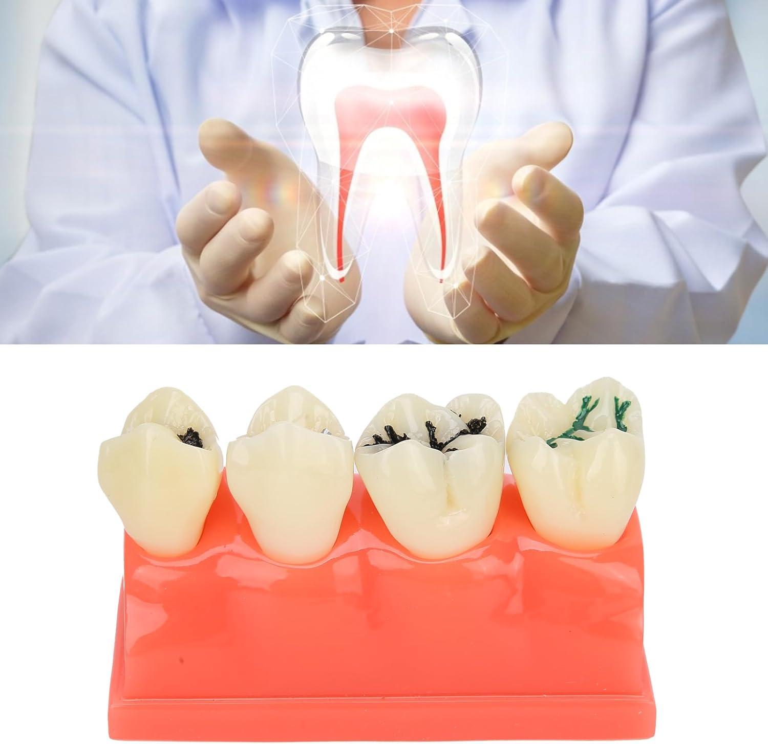 Ververt Touch Tooth Model - 180mm Dental Caries Demonstration Model for ...