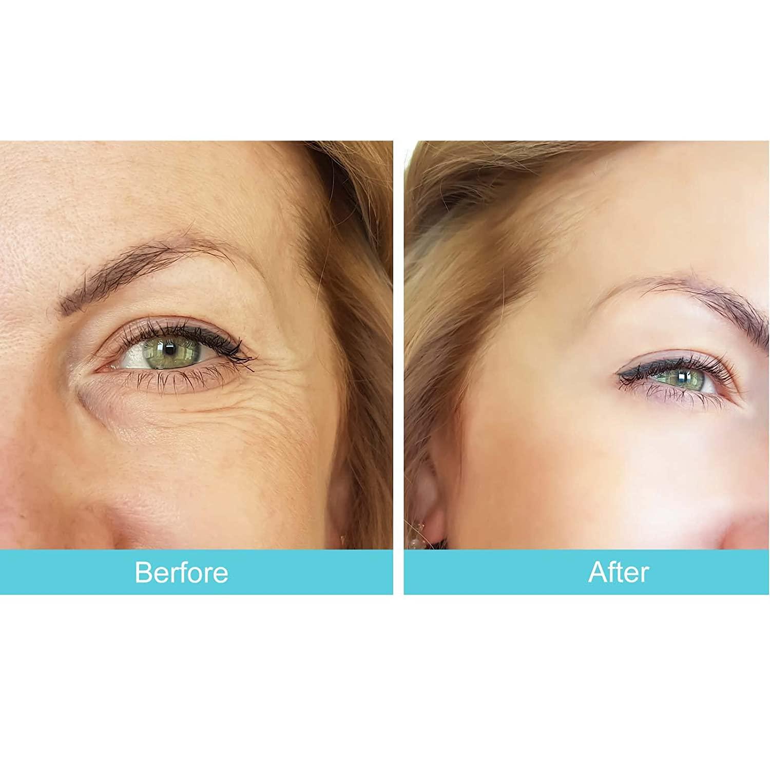 Rosetra Face Tape Set 160 Pcs Anti Wrinkle Strips for Forehead, Eyes