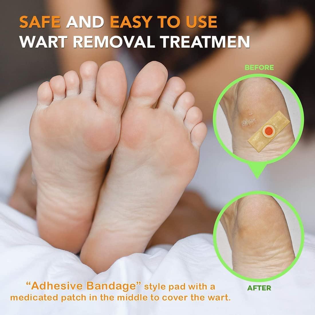 Samsali Wart Remover Pads, Highly Potent Wart Removal Treatment, All