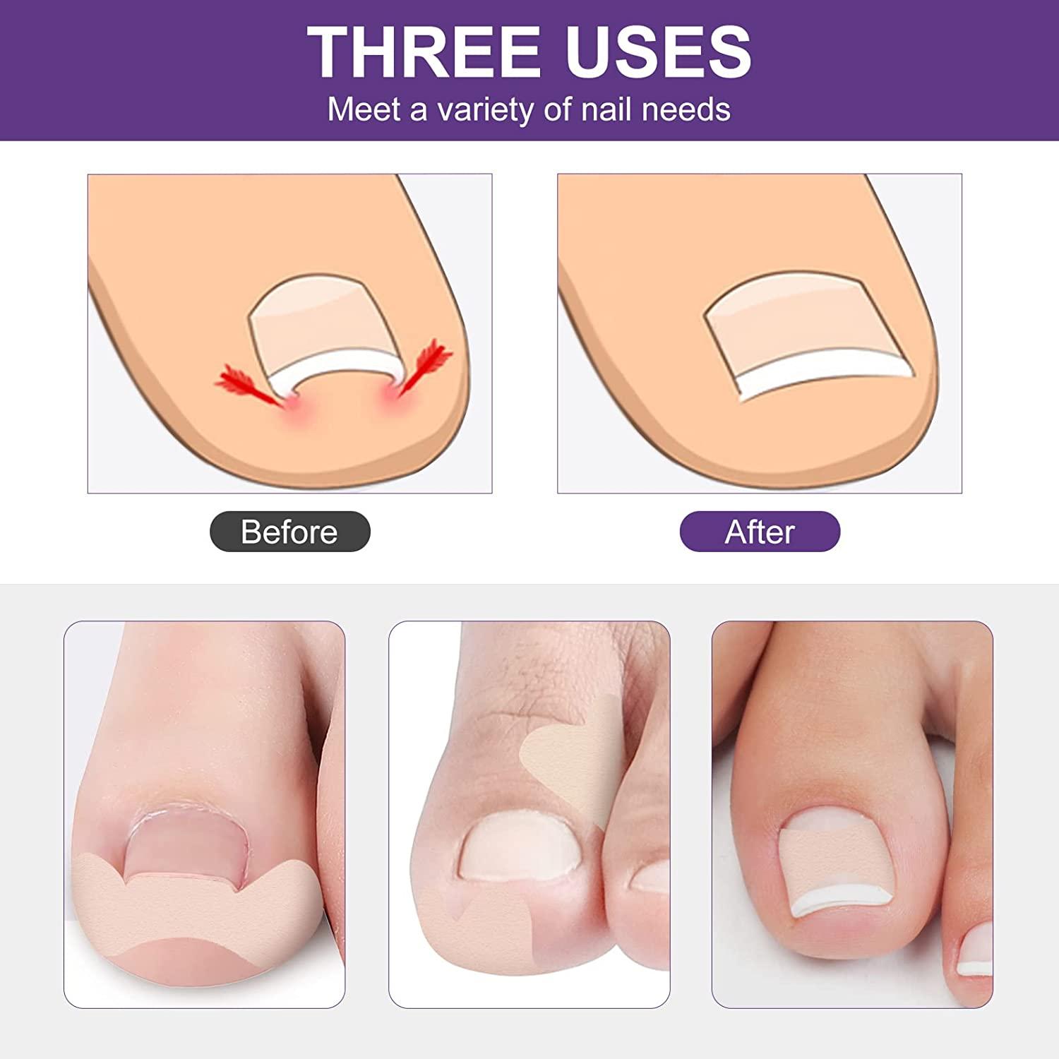 IngrownToenailTreatment IngrownToenailPainRelief IngrownToenail