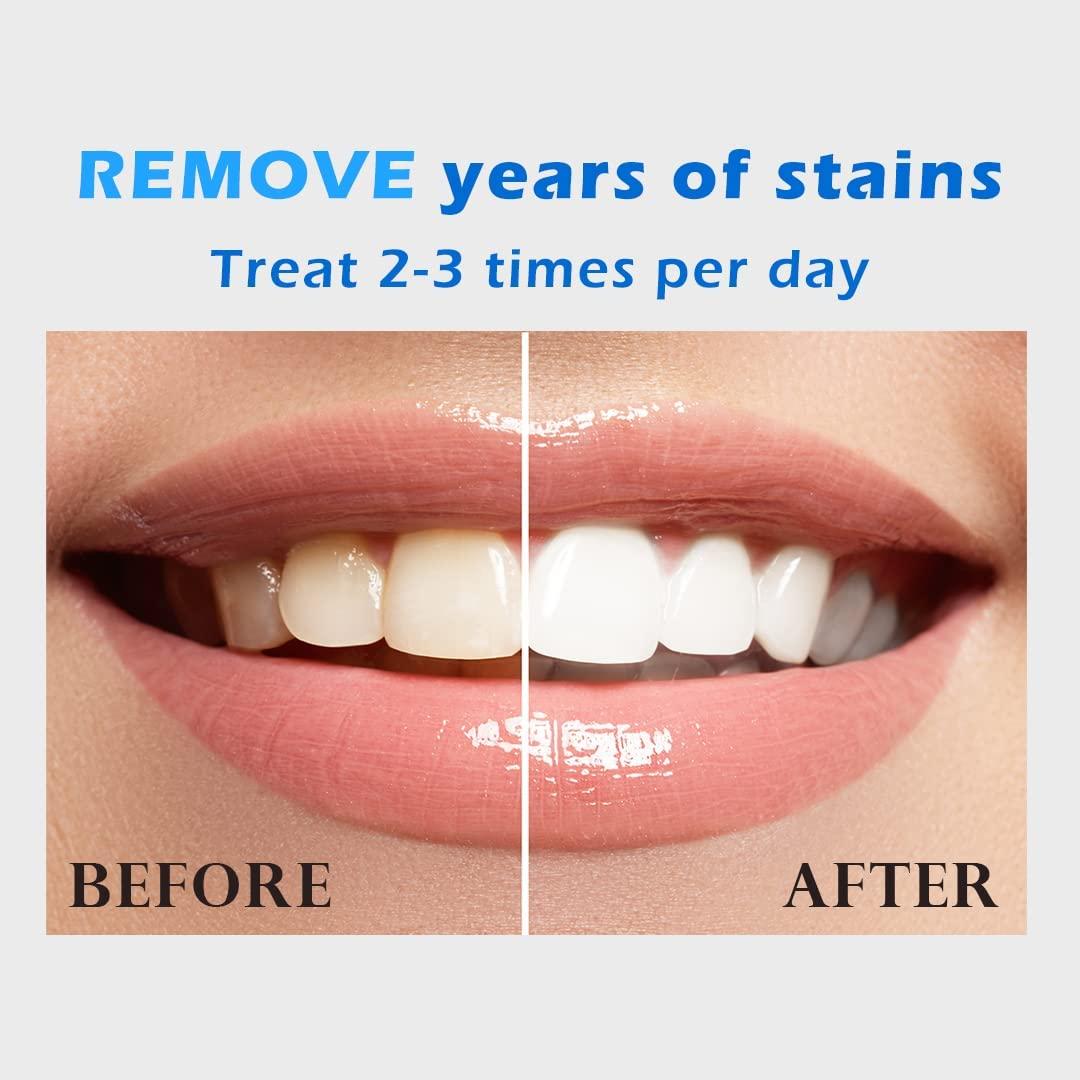 Venus Visage Teeth Whitening Pen (4 Pens), 40+ Uses, Effective&Painless