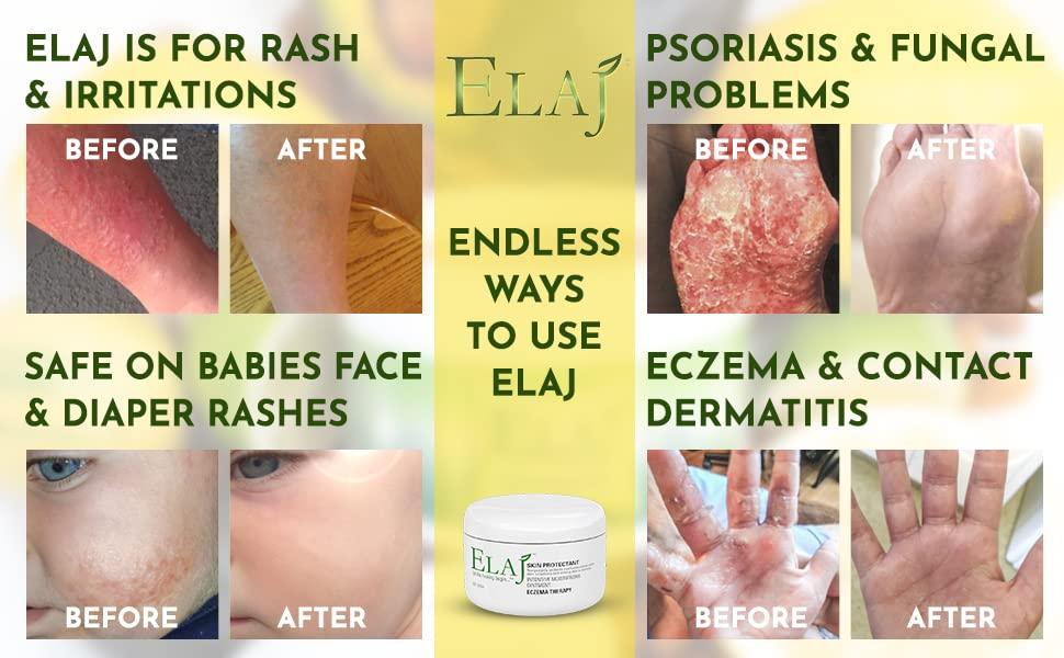 ELAJ All Natural Eczema Skin Care Moisturizing Lotion Cream Helps