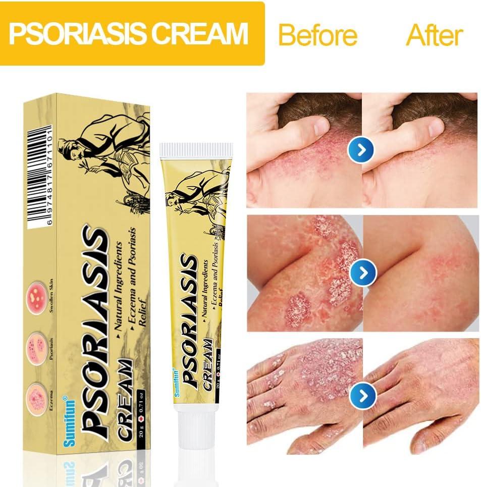 Sumifun Chinese Herbal Psoriasis Eczema Cream AntiItch Relief for