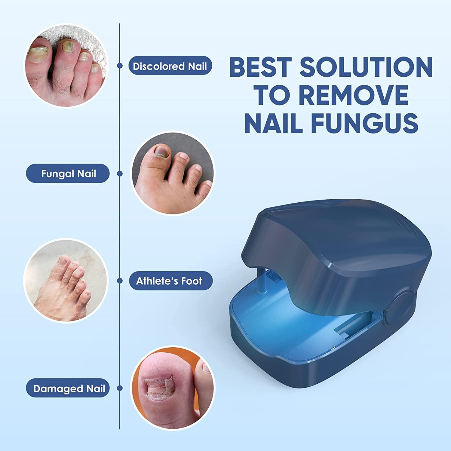 Nail Fungus Laser Treatment Device, Fungus Laser Cleaning Device for