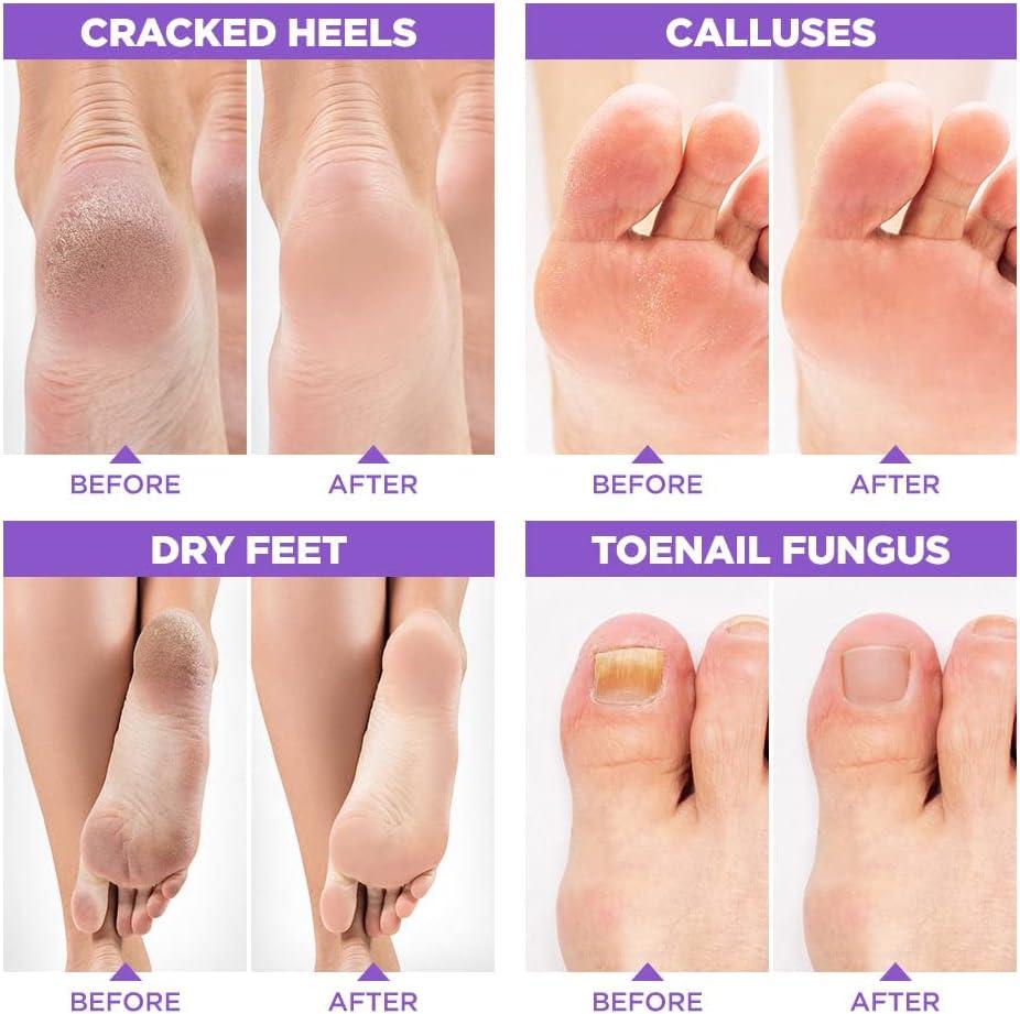 The Best Home Remedies For Cracked Heels