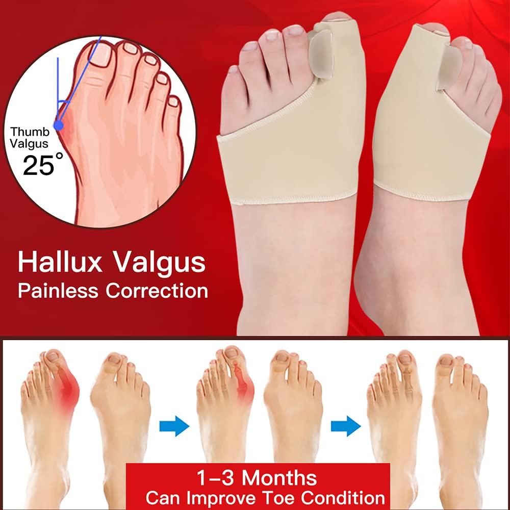 Bunion Corrector, Feedlex Hallux Valgus Brace Splint Pads Bunion Big