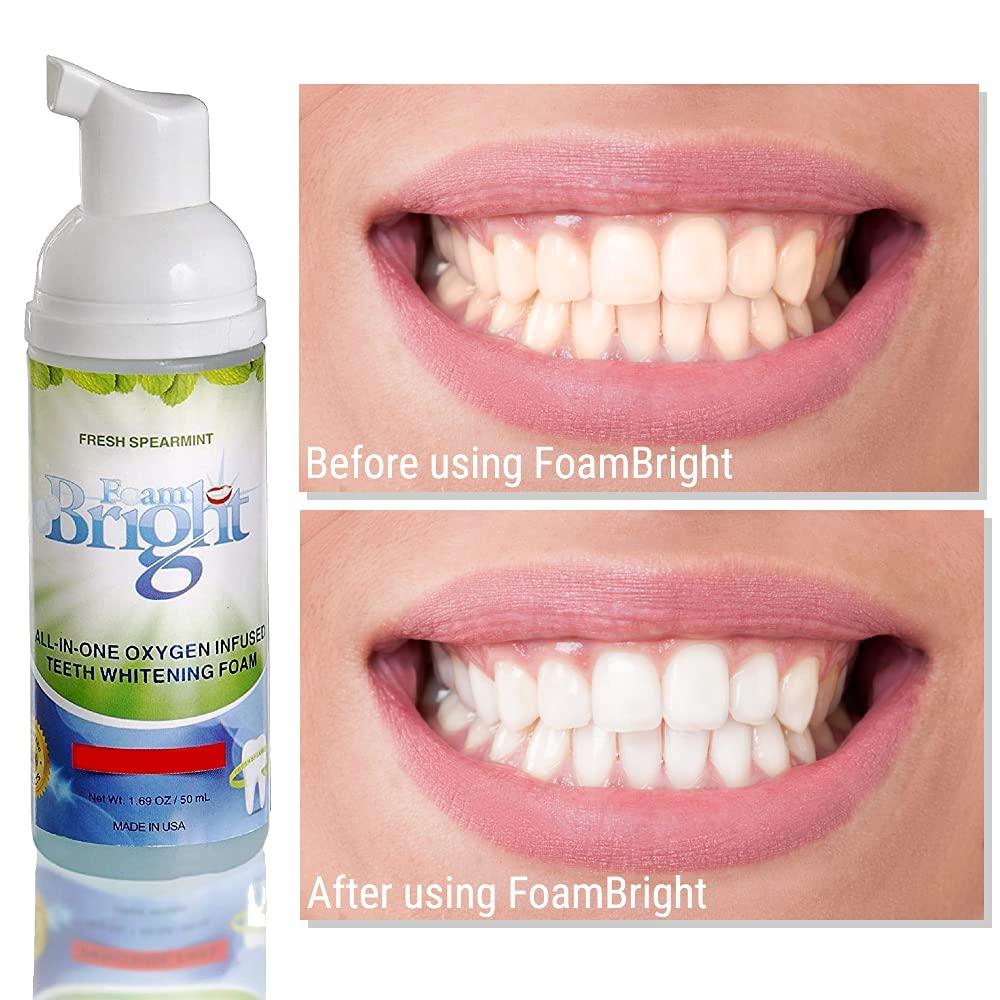FoamBright 2in1 Aligner/Retainer Cleaner Stain Remover & Teeth