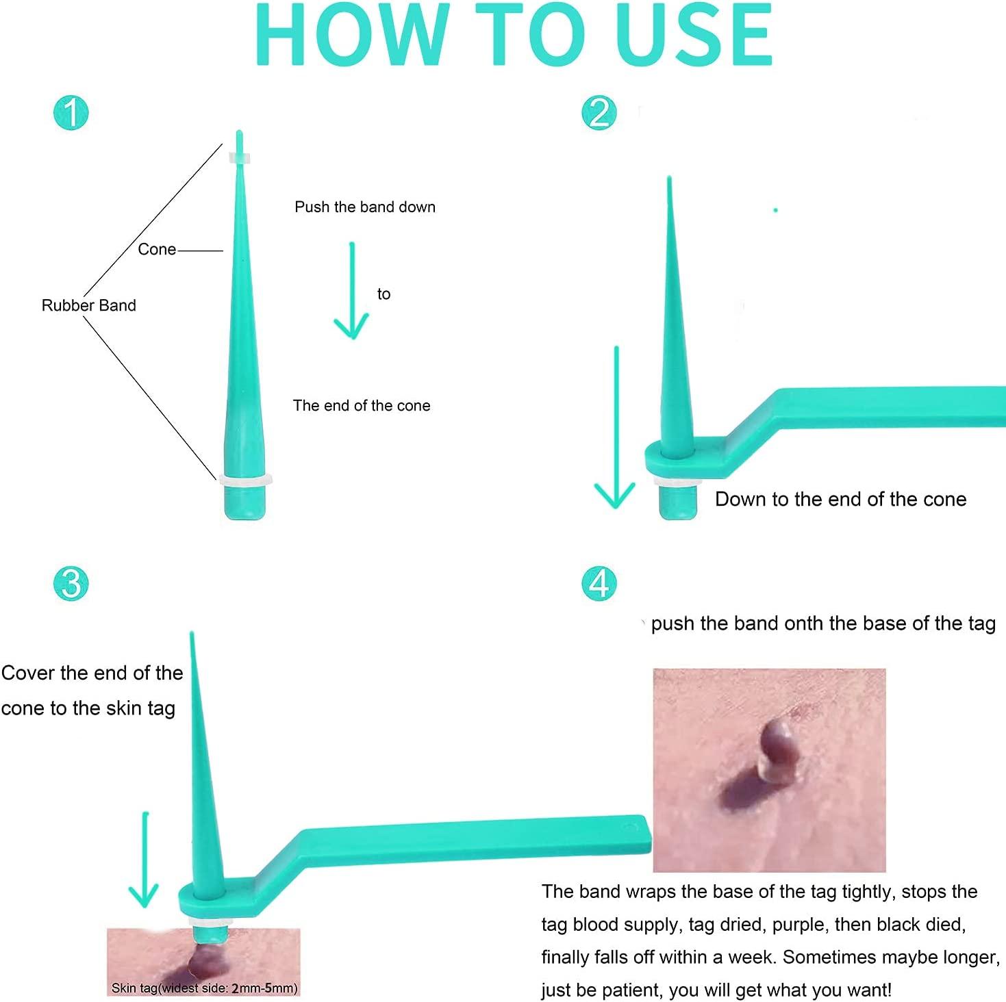 77PCS Skin Tag Remover for 25mm Skin Tag, Skin Tag Remover Patches