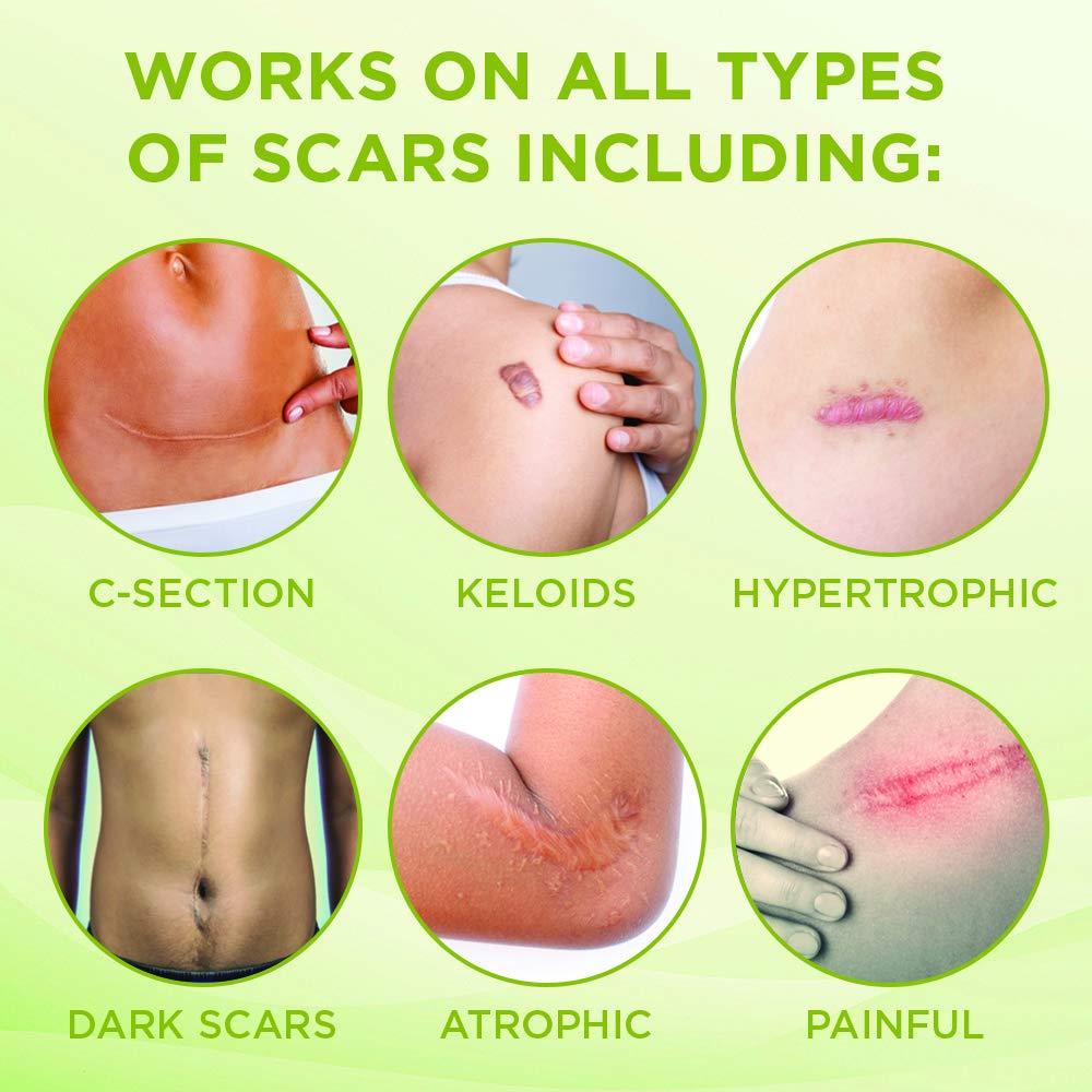 KELODA Scar & Keloid Removal Butter Stick with Menthol Cooling Balm for Painful Irritated