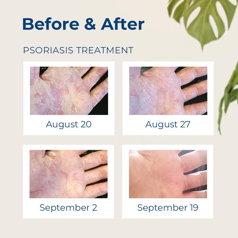 Shielding Lotion for Eczema & Psoriasis Relief 3.4 oz (Pack of 2