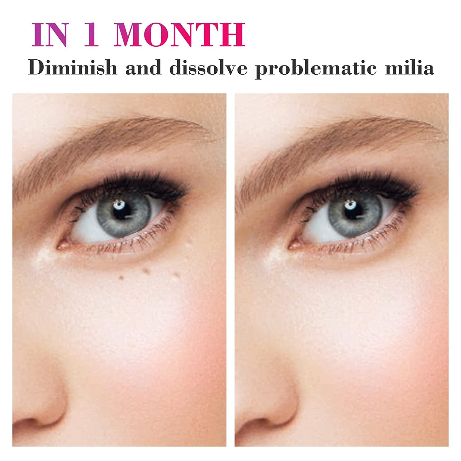 ZOHRAA Milia Remover Milia Spot Treatment Helps Dissolve and Reduce