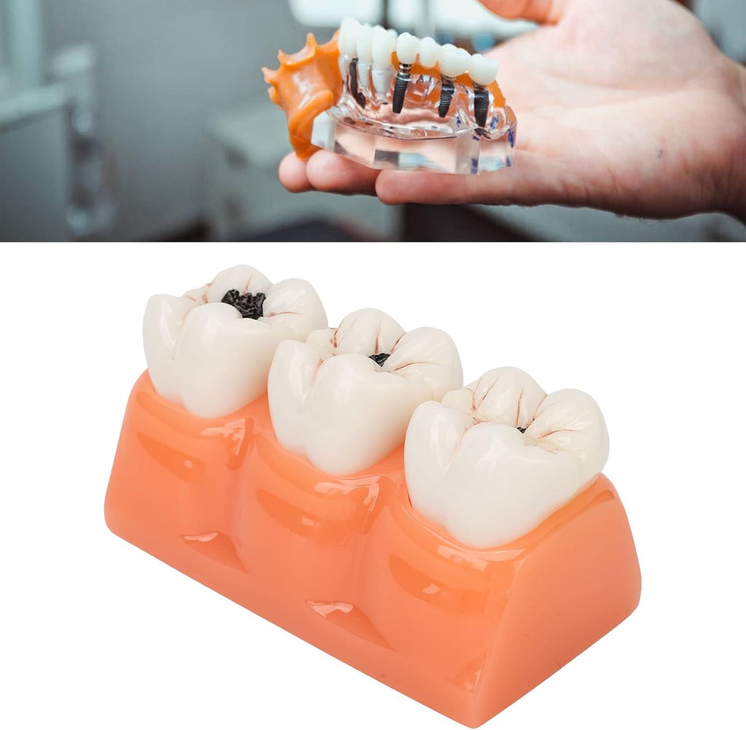 4-Fold Dental Caries Model - Synthetic Resin Oral Care Training Tool ...
