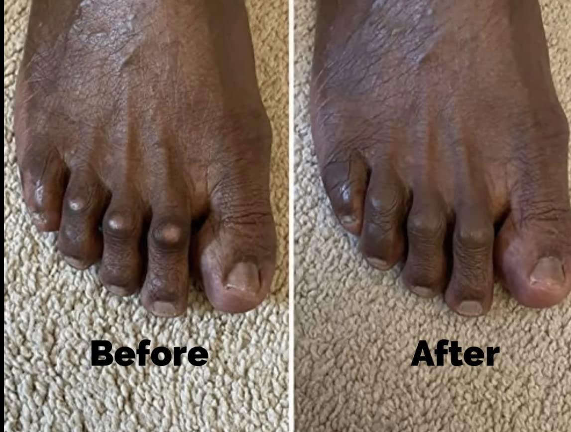 CORNCEALER Toe Corn Concealer Instantly Hide Toe Corns