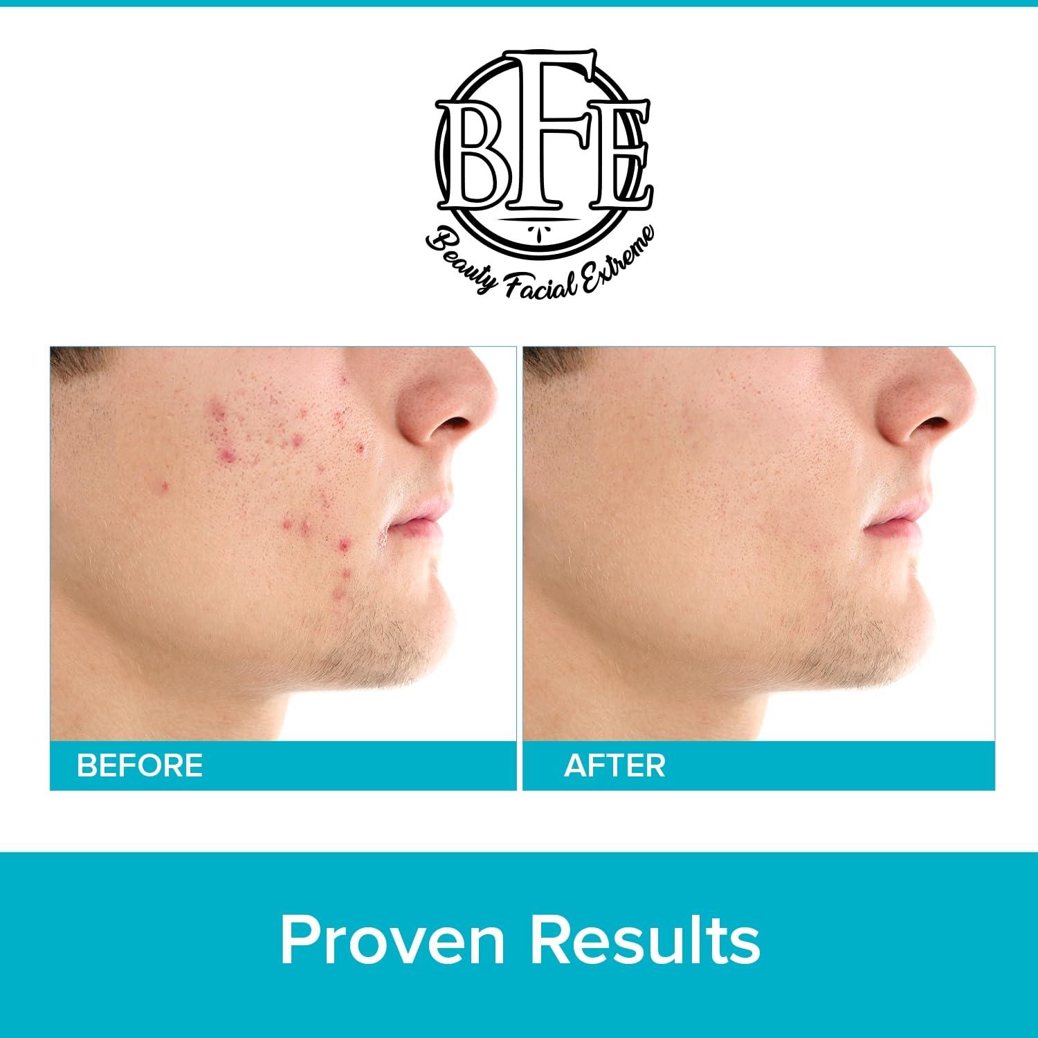 Acne Treatment Pads Contains Salicylic Glycolic & Lactic Acid for Face