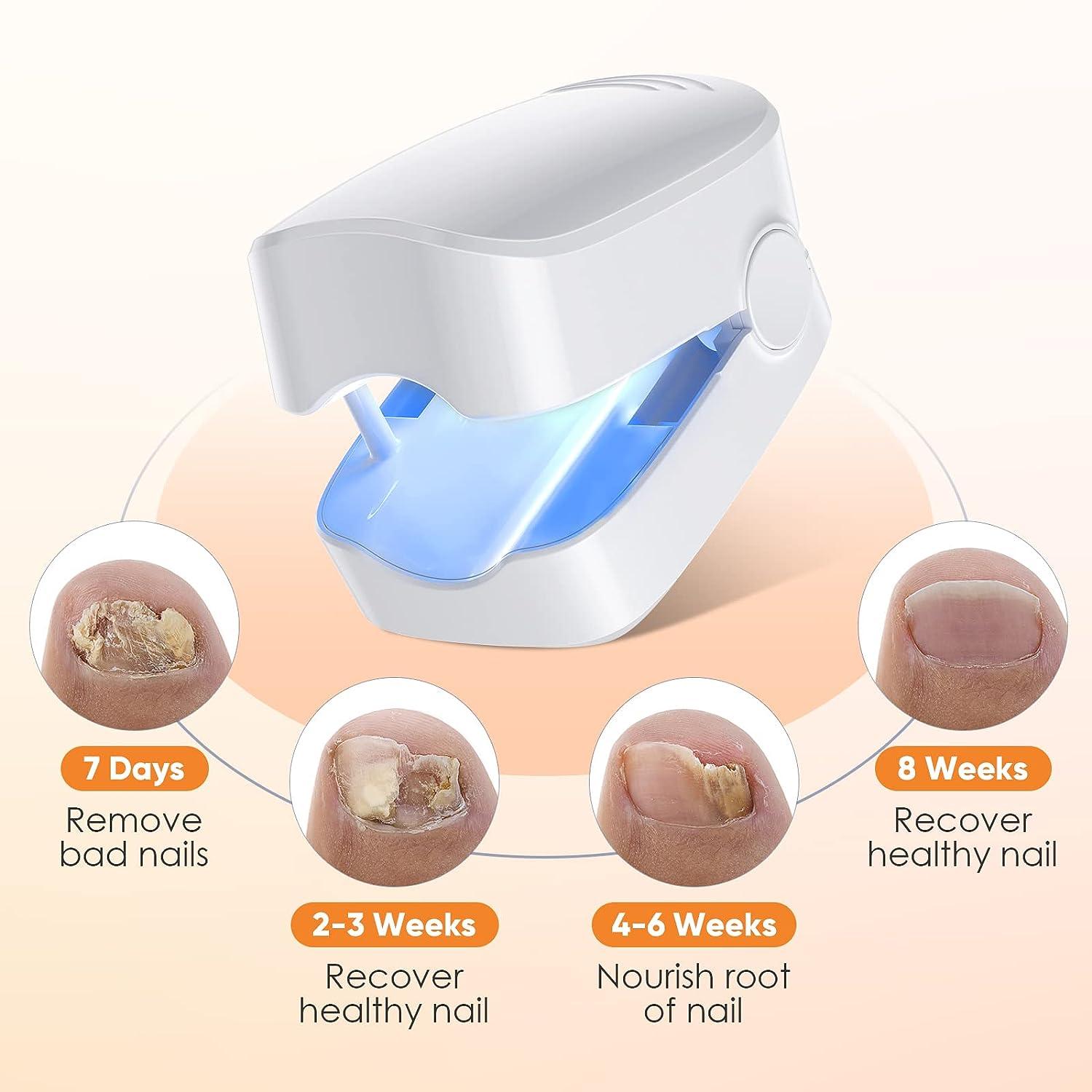 Nail Fungus Cleaning Laser Device for Onychomycosis Nail Fungus Laser