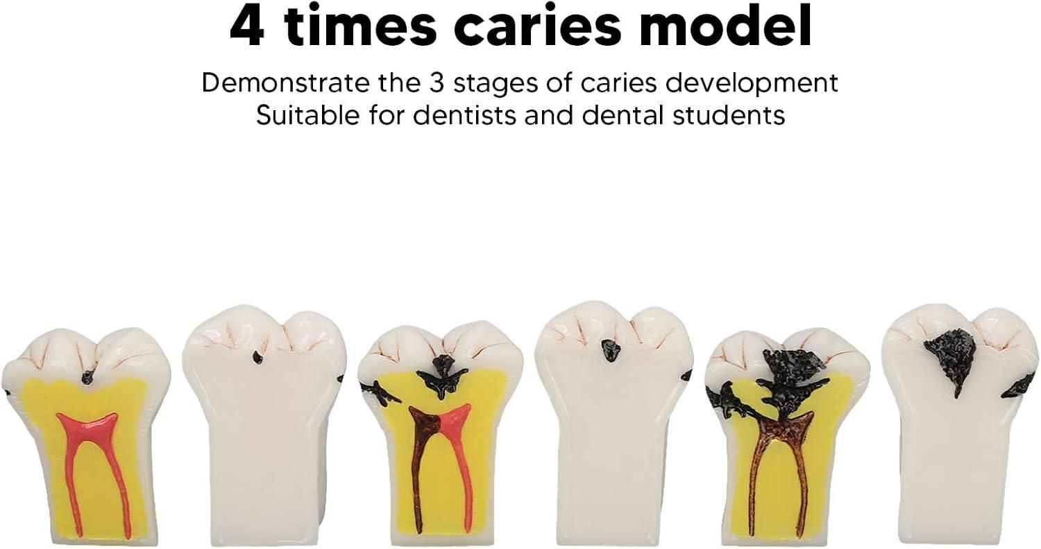 4-Fold Dental Caries Model - Synthetic Resin Oral Care Training Tool ...