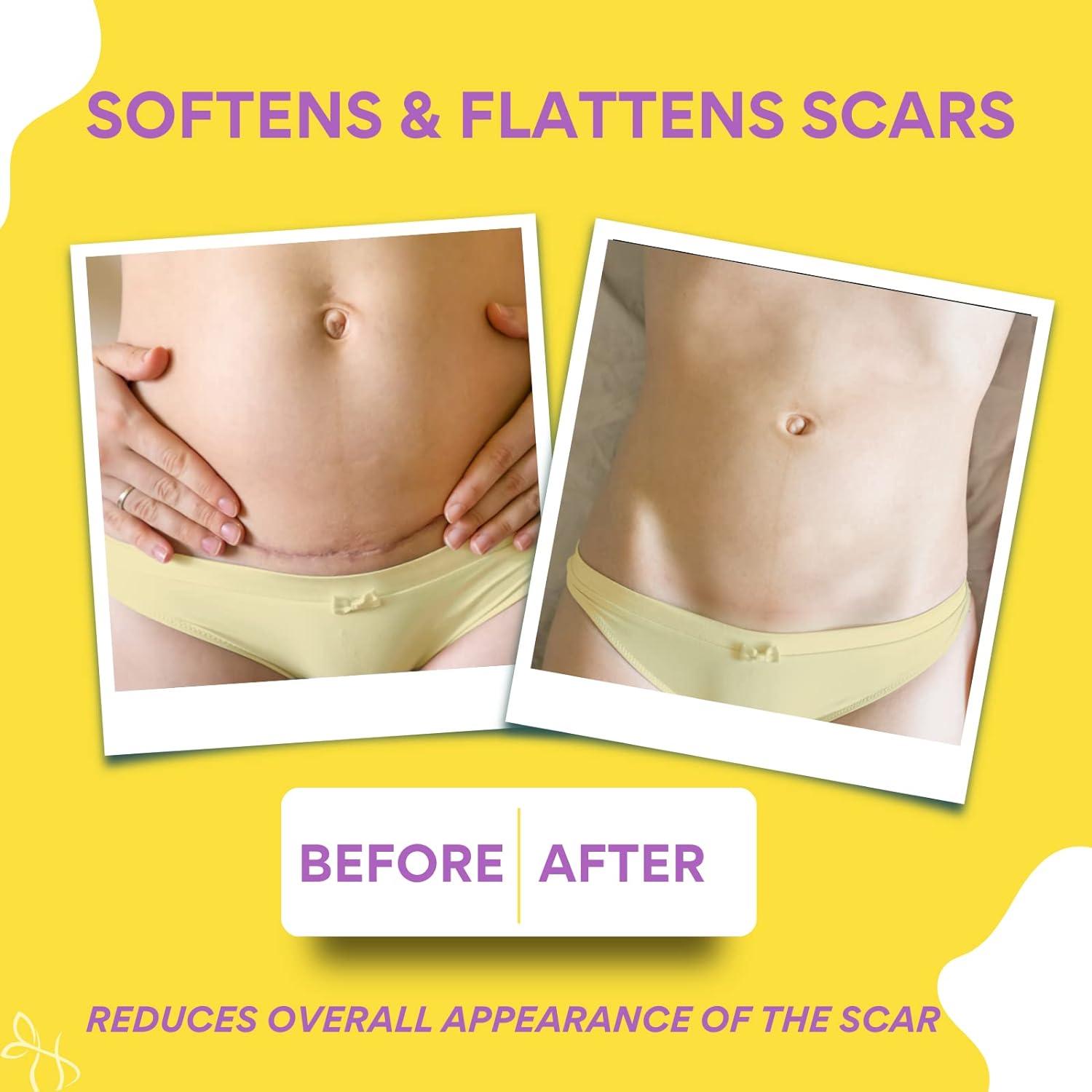 ENQLI CSection Scar Silicone Strips (6 Pack) Reusable Medical Grade