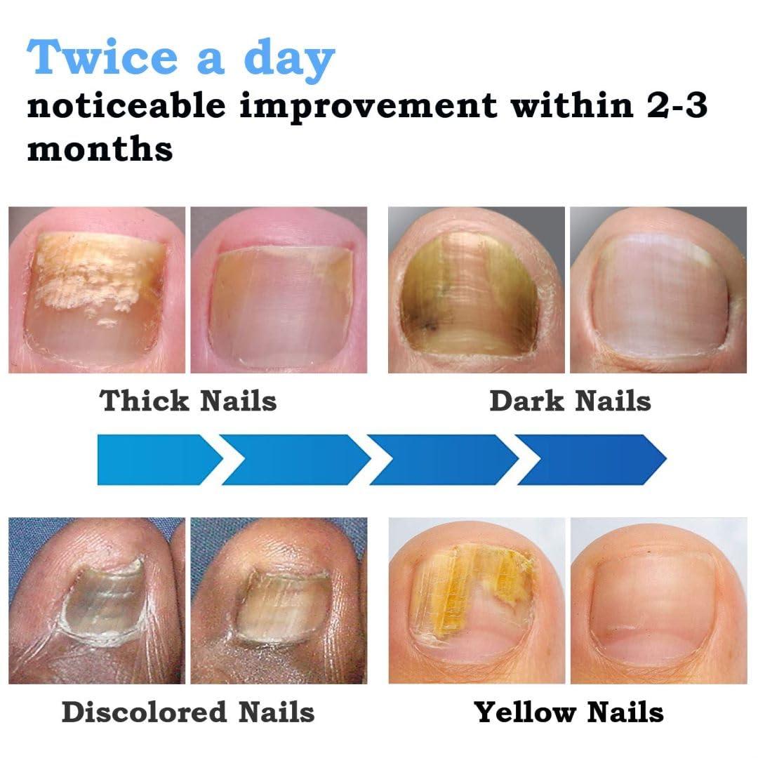 Nail Fungus Cleaning Laser Treatment Device Effective HomeUse