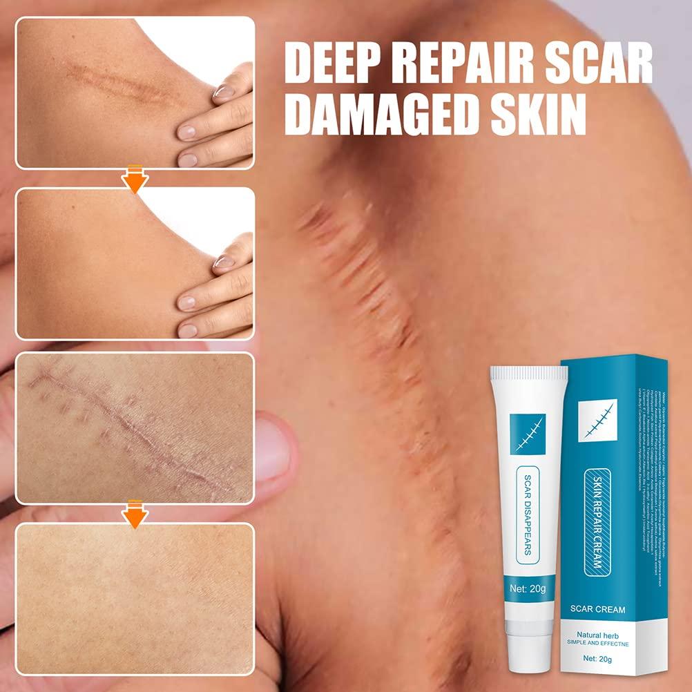 Acne scar treatment top products