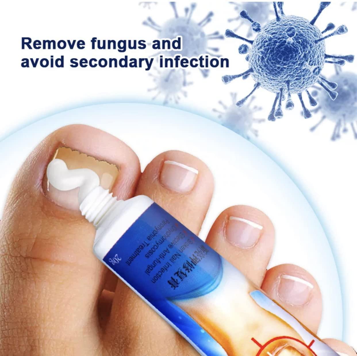 Toenail affected by the fungus. Nail Care. Cream in a jar, cotton pads and  cotton buds. - Warner Orthopedics