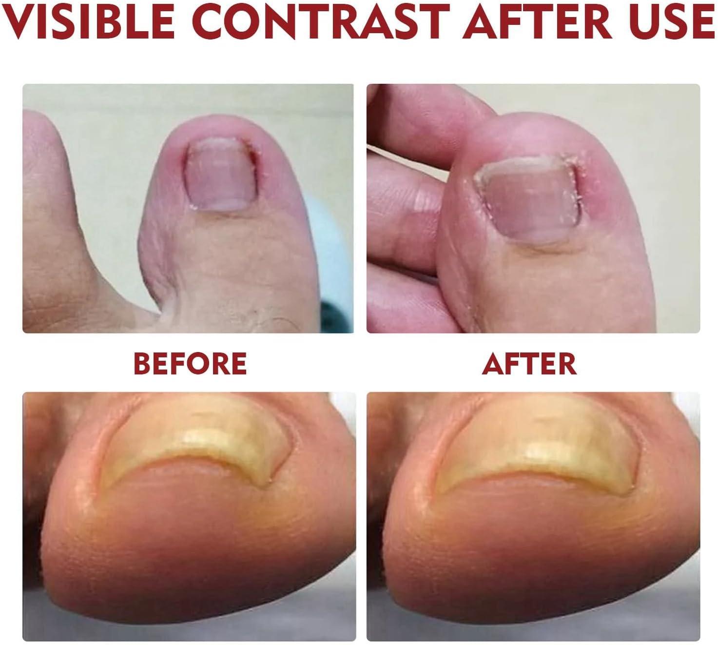 Toenail Broken Damaged Repair Solution Discolored Smooth Nails Renew  Treatment | eBay