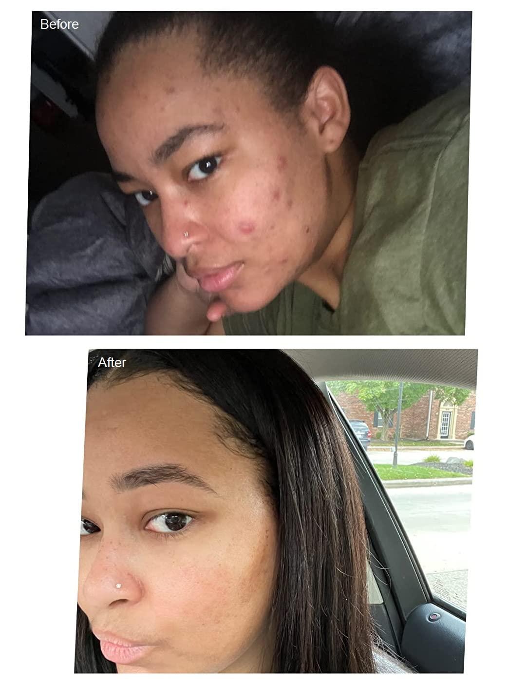 Admire My Skin Dark Spot Corrector Remover for Face Brightening Serum