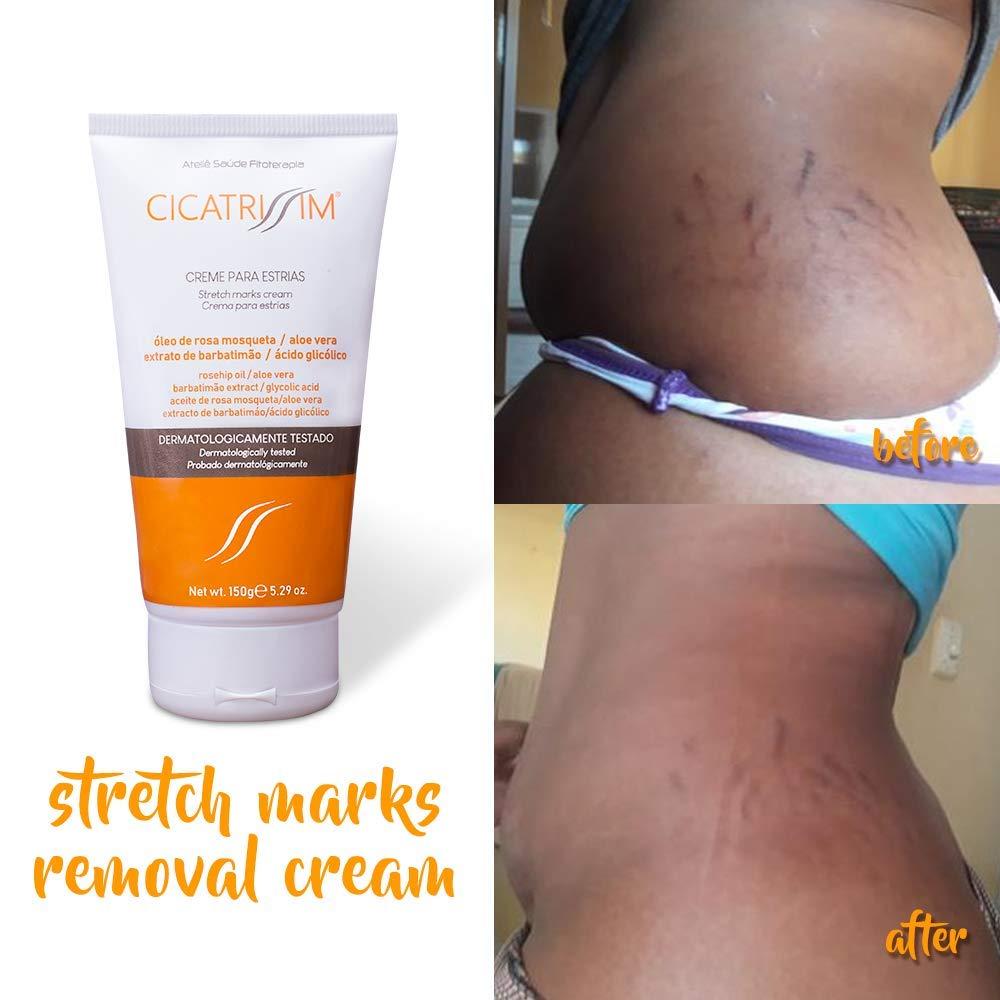 Cicatrissim Stretch Marks Cream Innovative Formula With Pure and