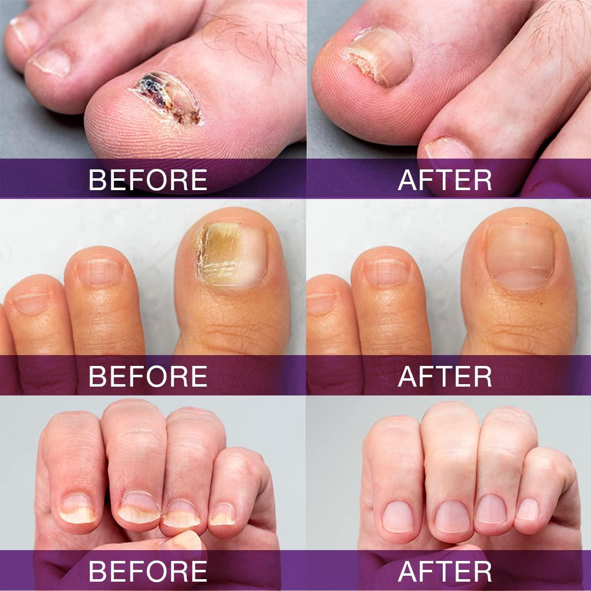 Fungal Nail Treatment | Skin Care Solution Specialists | Refresh Evolution