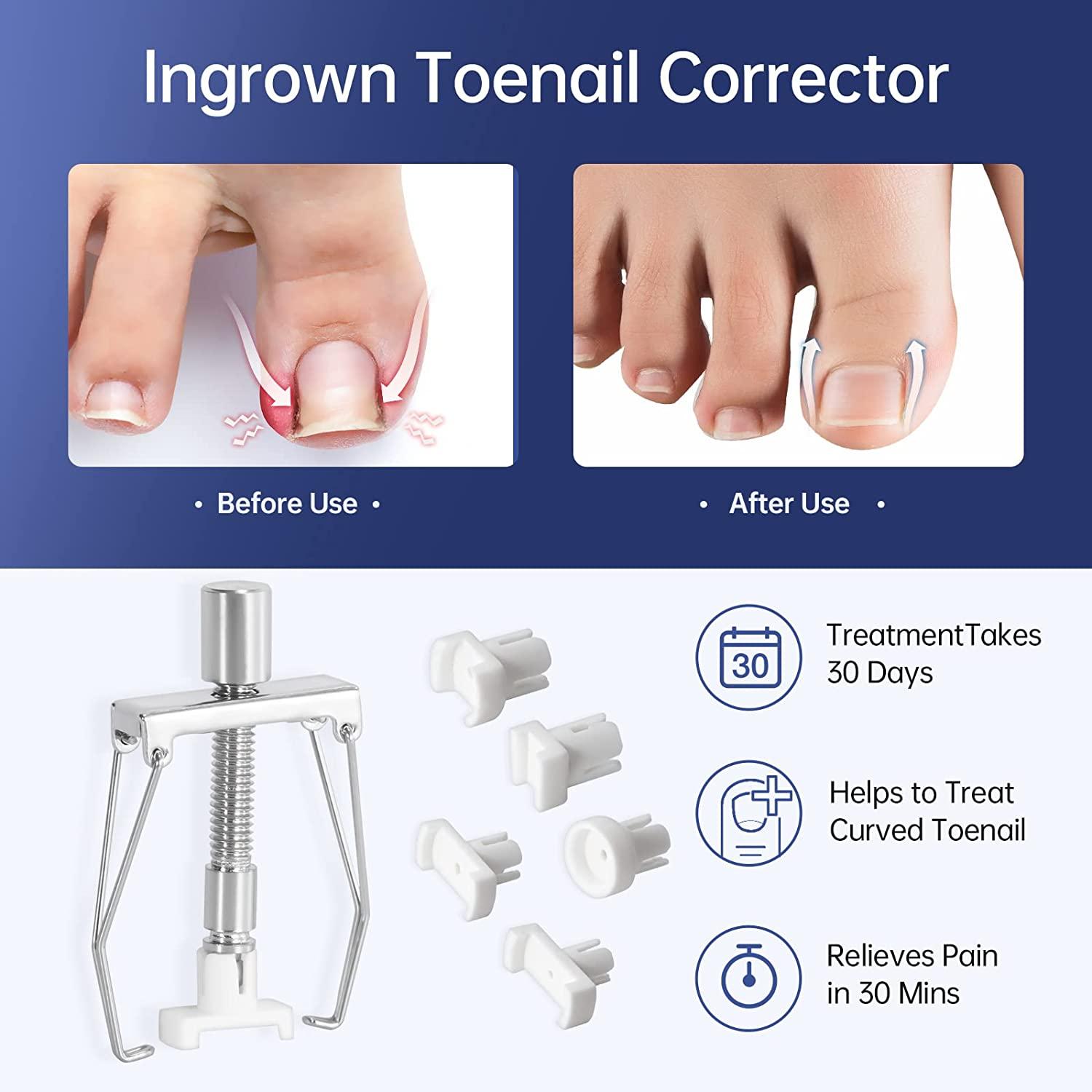 Ingrown Toenail Treatment Kit with 12 Podiatry Braces Corrector Tool & 50pcs Patch 10 Strips