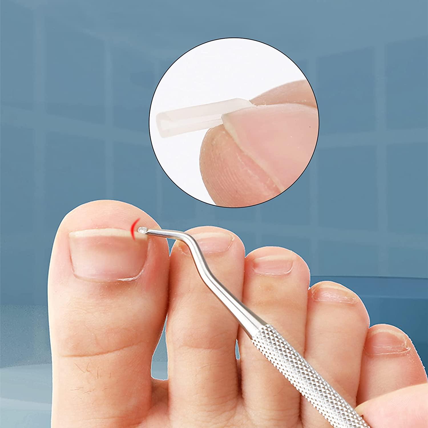 (30+2) Pack Ingrown Toenail Correction Treatment Kit, 30PCS Ingrown