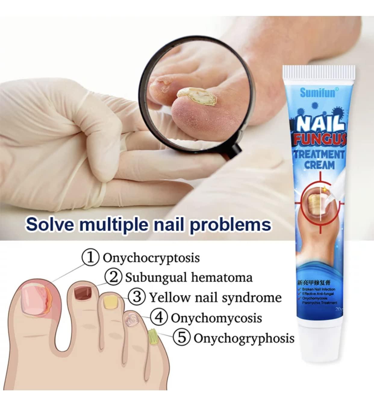 NO MORE Nail Fungus | Original SUMIFUN Nail Fungus Treatment Cream |  Antibacterial Nail Cream, Improves
