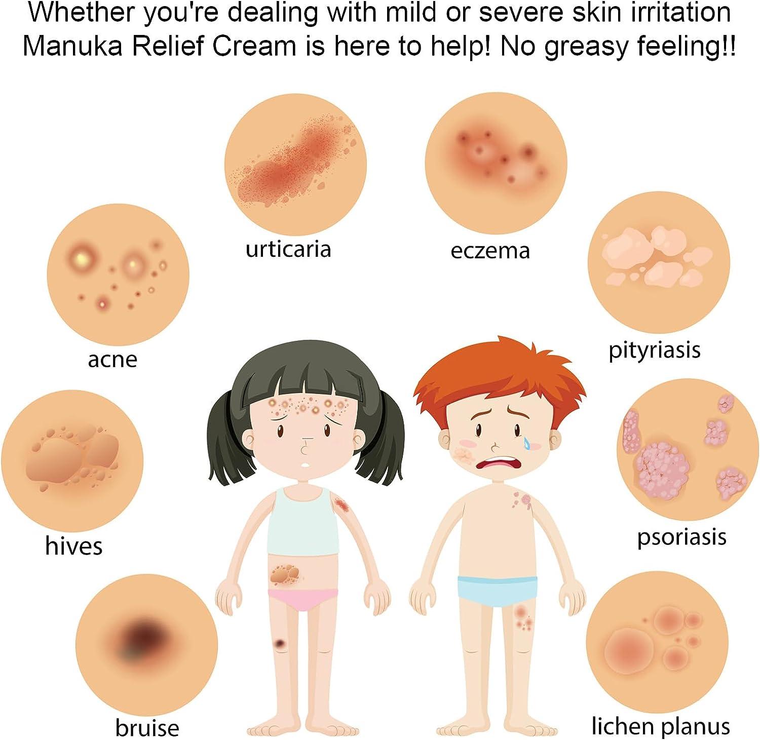 Manuka Honey Cream for Eczema, Psoriasis, Tinea Versicolor More