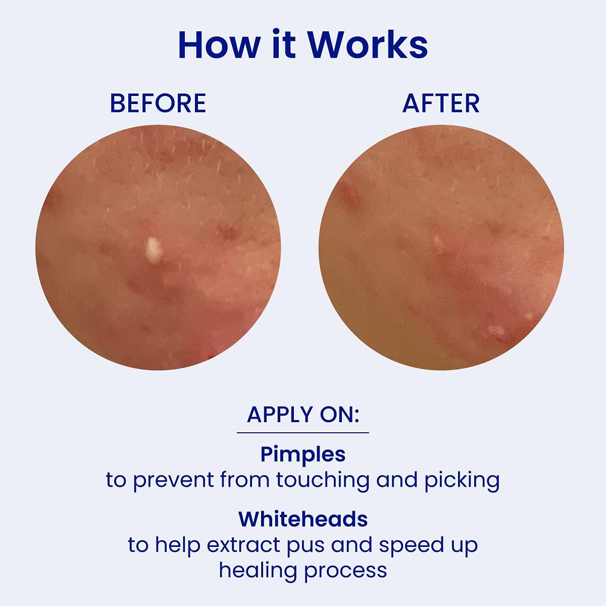 FaceTory Spot Fighter Acne Blemish Patches (150 Count) Hydrocolloid